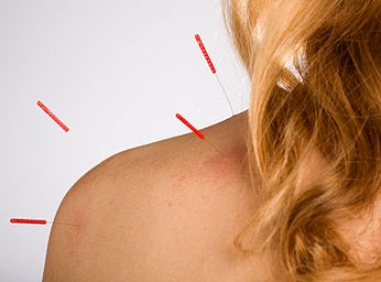 Is Acupuncture Safe?
