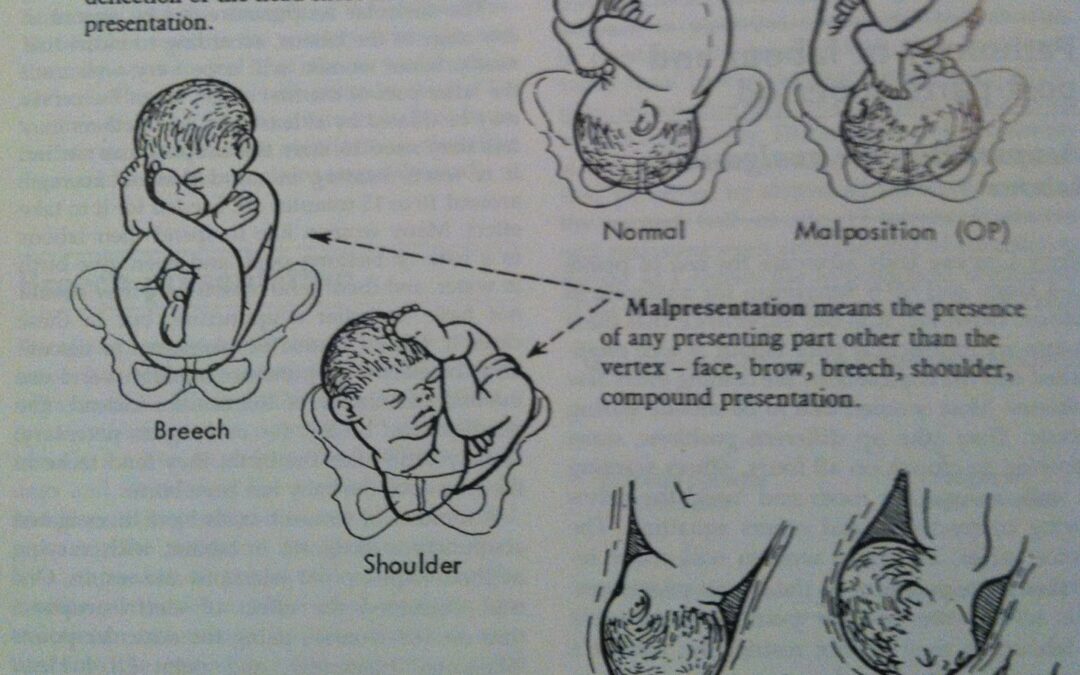 malposition