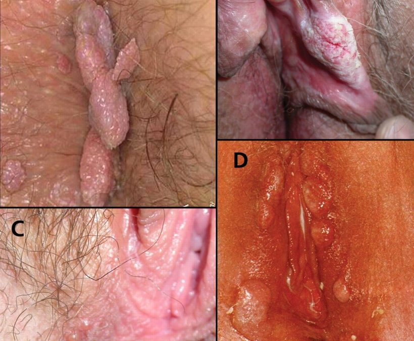 Vulvar Neoplasia (Warts, etc.) & TCM