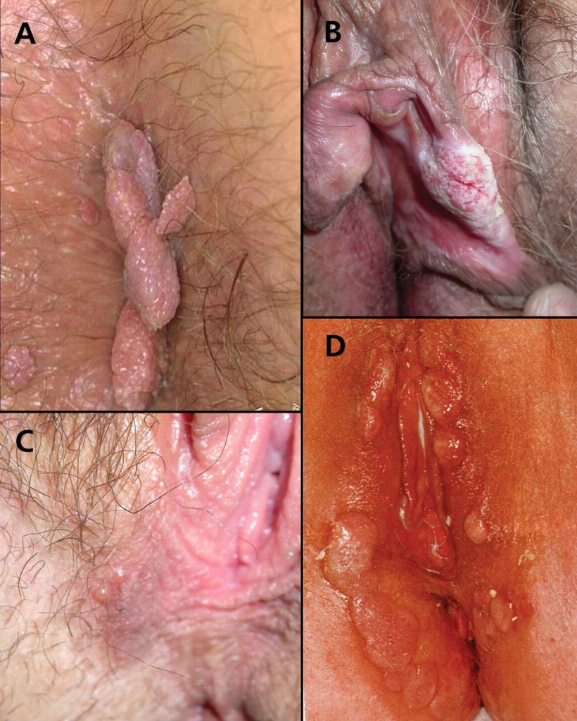можно ли заразится сифилисом при мастурбации фото 34